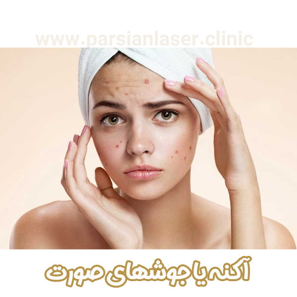 آکنه یا جوشهای صورت - https://parsianlaser-clinic.com/