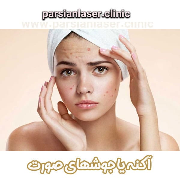 آکنه یا جوشهای صورت از دکتر سیما اعلمی هرندی در بندرعباس-parsianlaser.clinic