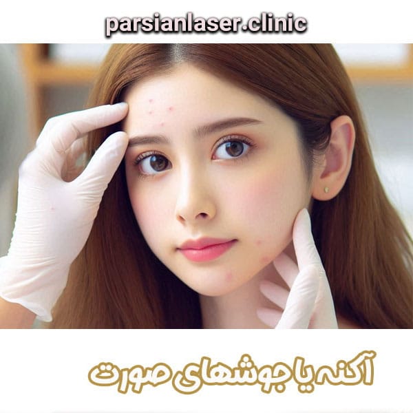 آکنه - دکتر سیمار اعلمی هرندی -parsianlaser.clinic