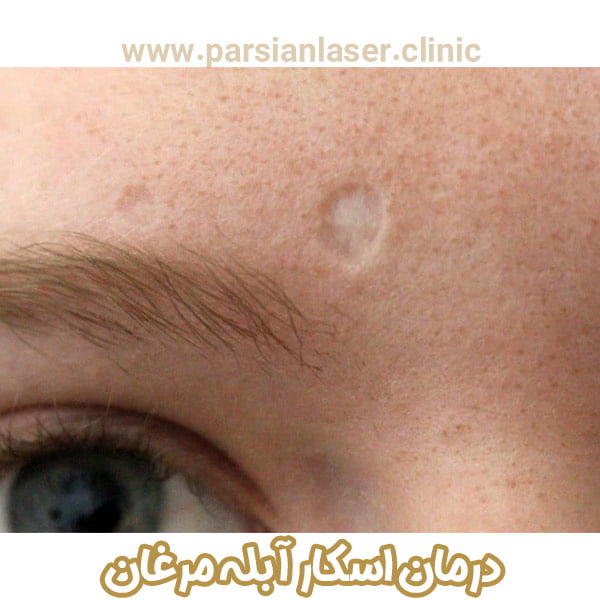 درمان اسکار آبله مرغان - https://parsianlaser-clinic.com/