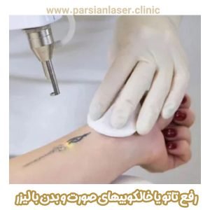 رفع تاتو یا خالکوبیهای صورت و بدن با لیزر - https://parsianlaser-clinic.com/