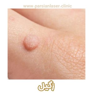 زگیل - https://parsianlaser-clinic.com/