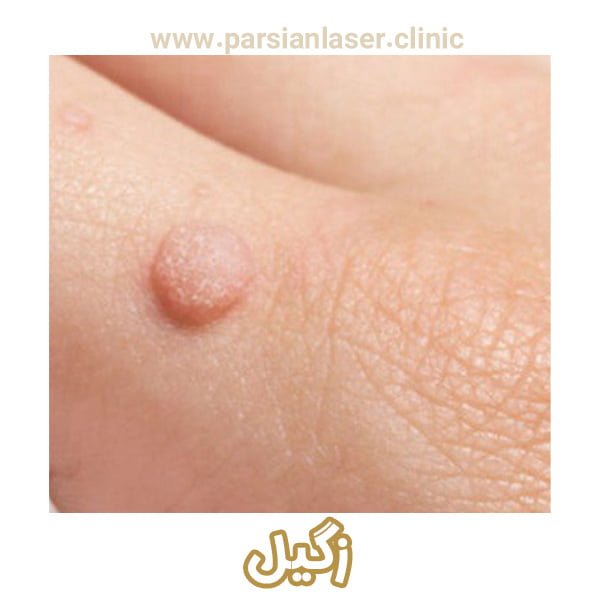 زگیل - https://parsianlaser-clinic.com/