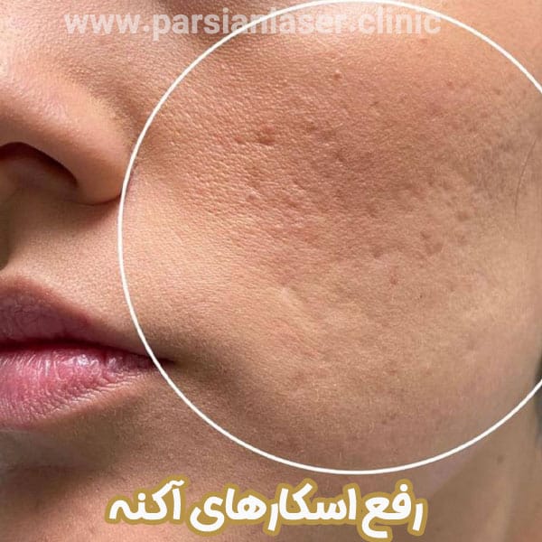 رفع اسکارهای آکنه